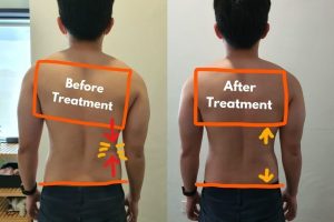 myofascial release